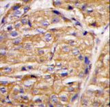 Formalin-fixed and paraffin-embedded human breast carcinoma tissue reacted with MIPEP antibody , which was peroxidase-conjugated to the secondary antibody, followed by DAB staining. This data demonstrates the use of this antibody for immunohistochemistry; clinical relevance has not been evaluated.