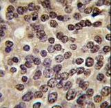 Formalin-fixed and paraffin-embedded human prostate carcinoma tissue reacted with PKN beta antibody , which was peroxidase-conjugated to the secondary antibody, followed by DAB staining. This data demonstrates the use of this antibody for immunohistochemistry; clinical relevance has not been evaluated.