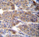 PLA2G2C Antibody immunohistochemistry of formalin-fixed and paraffin-embedded human melanoma followed by peroxidase-conjugated secondary antibody and DAB staining.