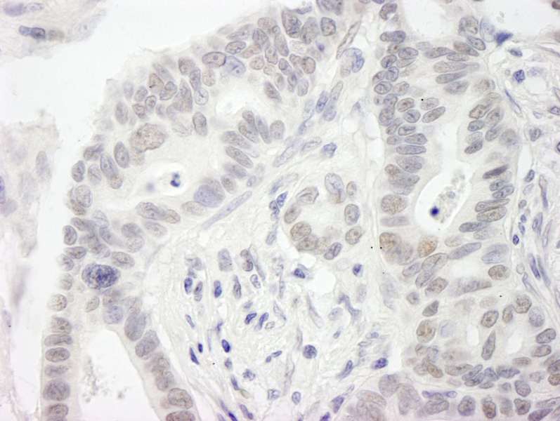 Detection of Human MIS12 by Immunohistochemistry. Sample: FFPE section of human stomach adenocarcinoma. Antibody: Affinity purified rabbit anti-MIS12 used at a dilution of 1:250. Epitope Retrieval Buffer-High pH (IHC-101J) was substituted for Epitope Retrieval Buffer-Reduced pH.
