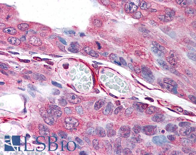 Anti-PLA2G3 antibody LS-A9486 IHC of human colon carcinoma. Immunohistochemistry of formalin-fixed, paraffin-embedded tissue after heat-induced antigen retrieval.