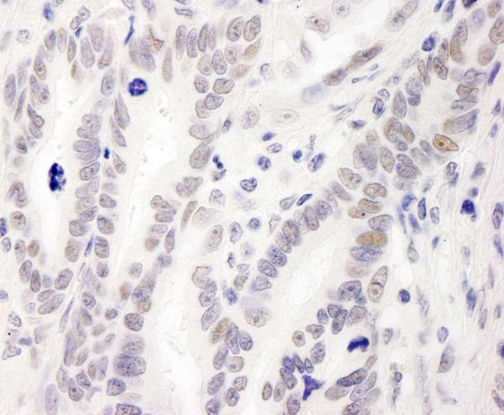 Detection of Human MIS12 by Immunohistochemistry. Sample: FFPE section of human stomach carcinoma. Antibody: Affinity purified rabbit anti-MIS12 used at a dilution of 1:1000 (1 Detection: DAB.
