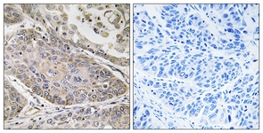 IHC of paraffin-embedded human lung carcinoma, using PLA2G4E Antibody. The picture on the right is treated with the synthesized peptide.