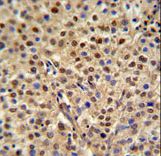 C19orf21 Antibody IHC of formalin-fixed and paraffin-embedded human cervix carcinoma followed by peroxidase-conjugated secondary antibody and DAB staining.