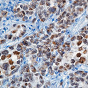 Formalin-fixed, paraffin-embedded human melanoma stained with peroxidase-conjugate and DAB chromogen. Note nuclear staining of tumor cells.