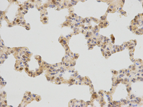 Immunohistochemistry of paraffin-embedded human breast cancer using PLCB1 antibody at dilution of 1:200 (400x lens).