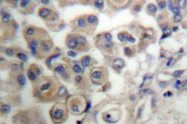 IHC of PLC 3 (L532) pAb in paraffin-embedded human breast carcinoma tissue.
