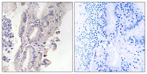 IHC of paraffin-embedded human lung carcinoma, using PLCXD1 Antibody. The picture on the right is treated with the synthesized peptide.