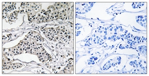 IHC of paraffin-embedded human breast carcinoma tissue, using PLD3 Antibody. The sample on the right was incubated with synthetic peptide.
