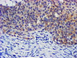 IHC of paraffin-embedded Adenocarcinoma of Human ovary tissue using anti-PLDN mouse monoclonal antibody. (Heat-induced epitope retrieval by 10mM citric buffer, pH6.0, 100C for 10min).