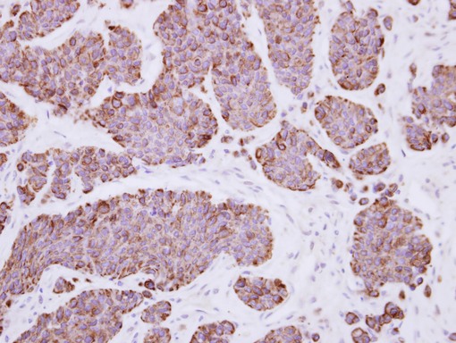 IHC of paraffin-embedded Breast ca, using PLEKHF2 antibody at 1:500 dilution.
