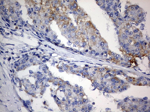 IHC of paraffin-embedded Carcinoma of Human liver tissue using anti-PLOD2 mouse monoclonal antibody. (Heat-induced epitope retrieval by 1 mM EDTA in 10mM Tris, pH8.5, 120°C for 3min).