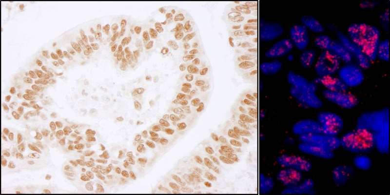 Detection of Human PLRG1 by Immunohistochemistry and Immunofluorescence. Sample: FFPE sections of human prostate carcinoma (left) and breast carcinoma (right). Antibody: Affinity purified rabbit anti-PLRG1 used at a dilution of 1:200 (1 ug/ml). Detection: DAB and Red-fluorescent Goat anti-Rabbit IgG-heavy and light chain, cross-adsorbed Antibody DyLight 594 Conjugated used at a dilution of 1:100.