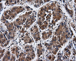 IHC of paraffin-embedded Carcinoma of liver tissue using anti-PPME1 mouse monoclonal antibody. (Dilution 1:50).
