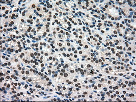 IHC of paraffin-embedded Carcinoma of thyroid tissue using anti-SILV mouse monoclonal antibody. (Dilution 1:50).
