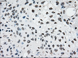 IHC of paraffin-embedded Carcinoma of pancreas tissue using anti-SILV mouse monoclonal antibody. (Dilution 1:50).
