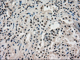 IHC of paraffin-embedded Carcinoma of prostate tissue using anti-SILV mouse monoclonal antibody. (Dilution 1:50).