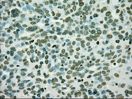 IHC of paraffin-embedded Adenocarcinoma of ovary tissue using anti-SILV mouse monoclonal antibody. (Dilution 1:50).