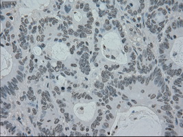 IHC of paraffin-embedded Adenocarcinoma of colon tissue using anti-SILV mouse monoclonal antibody. (Dilution 1:50).