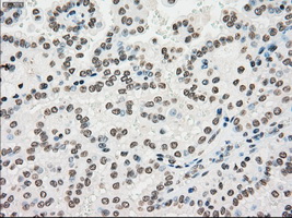 IHC of paraffin-embedded Carcinoma of kidney tissue using anti-SILV mouse monoclonal antibody. (Dilution 1:50).