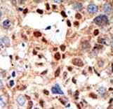Formalin-fixed and paraffin-embedded human cancer tissue reacted with the primary antibody, which was peroxidase-conjugated to the secondary antibody, followed by DAB staining. This data demonstrates the use of this antibody for immunohistochemistry; clinical relevance has not been evaluated. BC = breast carcinoma; HC = hepatocarcinoma.