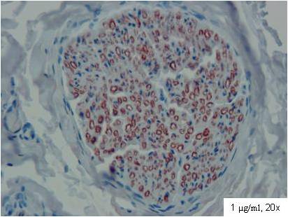 PMP22 staining in human paraffin embedded formalin fixed nerve section. Peripheral nerve myelin sheats are stained with monoclonal antibody CF1
