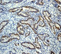 IHC of paraffin-embedded human colonic adenocarcinoma using anti-PMS2 antibody.