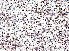 IHC of paraffin-embedded Carcinoma of Human kidney tissue using anti-PMS2 mouse monoclonal antibody. (Heat-induced epitope retrieval by 10mM citric buffer, pH6.0, 120°C for 3min).