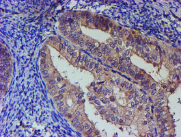 IHC of paraffin-embedded Adenocarcinoma of Human endometrium tissue using anti-PNMA3 mouse monoclonal antibody.