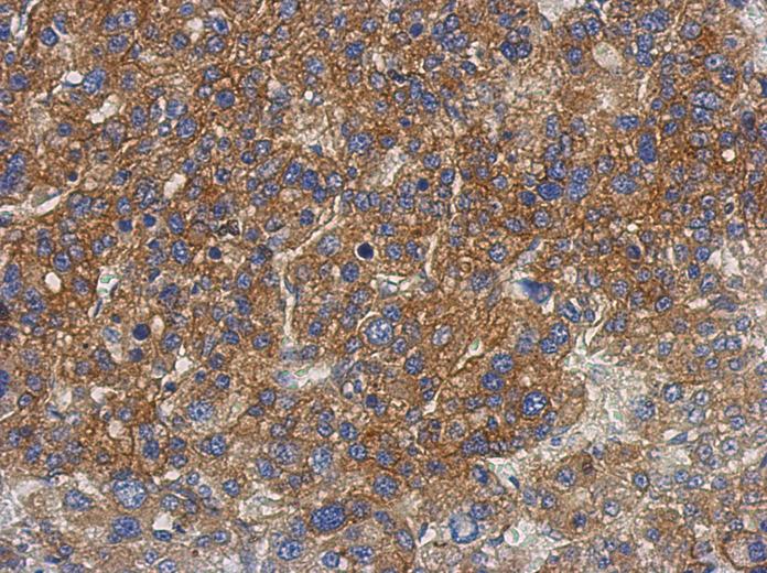 IHC of paraffin-embedded Hepatoma, using GS2 antibody at 1:500 dilution.