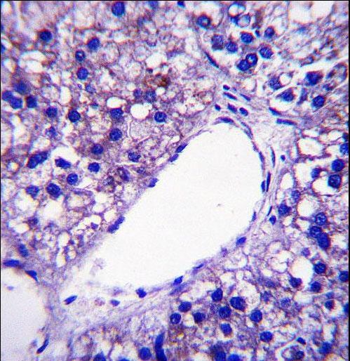 PNPLA4 Antibody immunohistochemistry of formalin-fixed and paraffin-embedded human hepatocarcinoma followed by peroxidase-conjugated secondary antibody and DAB staining.