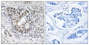 IHC of paraffin-embedded human breast carcinoma tissue, using PNPT1 Antibody. The picture on the right is treated with the synthesized peptide.