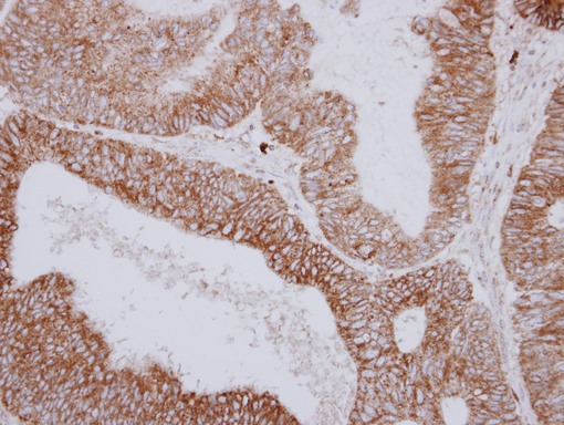 IHC of paraffin-embedded Colon ca using PNPase antibody at 1:250 dilution.
