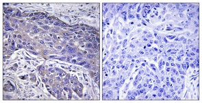 IHC of paraffin-embedded human lung carcinoma tissue, using POFUT1 Antibody. The picture on the right is treated with the synthesized peptide.
