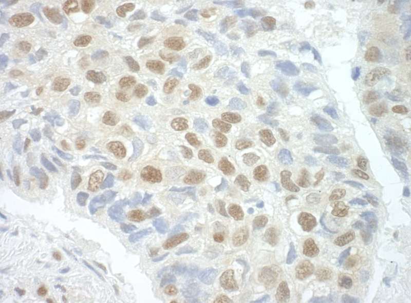 Detection of Human POGZ by Immunohistochemistry. Sample: FFPE section of human lung carcinoma. Antibody: Affinity purified rabbit anti-POGZ used at a dilution of 1:1000 (1 ug/ml). Detection: DAB.