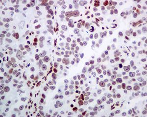 IHC of paraffin-embedded human ovarian carcinoma tissue using anti-POLE antibody.