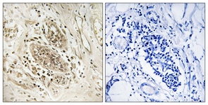 IHC of paraffin-embedded human breast carcinoma tissue, using POLE1 Antibody. The picture on the right is treated with the synthesized peptide.