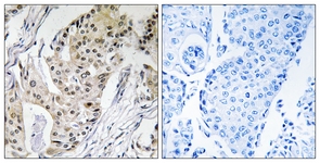 IHC of paraffin-embedded human breast carcinoma tissue, using POLE4 Antibody. The sample on the right was incubated with synthetic peptide.