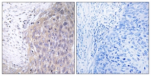 IHC of paraffin-embedded human cervix carcinoma tissue, using POLG2 Antibody. The picture on the right is treated with the synthesized peptide.