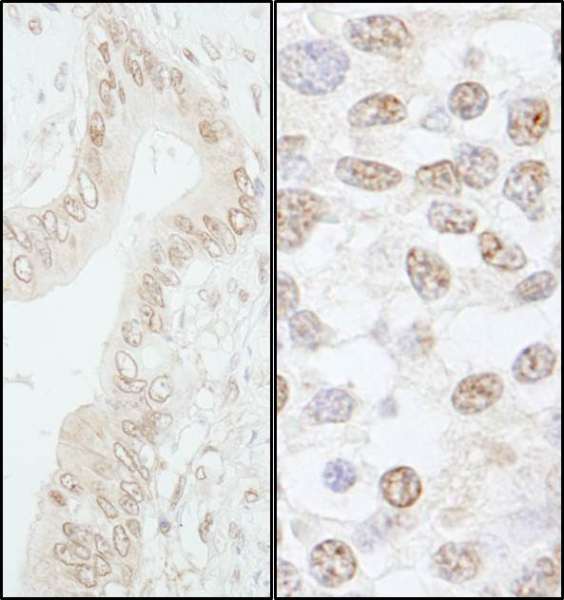 Detection of Human and Mouse Pol Lambda by Immunohistochemistry. Sample: FFPE section of human stomach carcinoma (left) and mouse teratoma (right). Antibody: Affinity purified rabbit anti-Pol Lambda used at a dilution of 1:1000 (1 ug/ml). Detection: DAB.