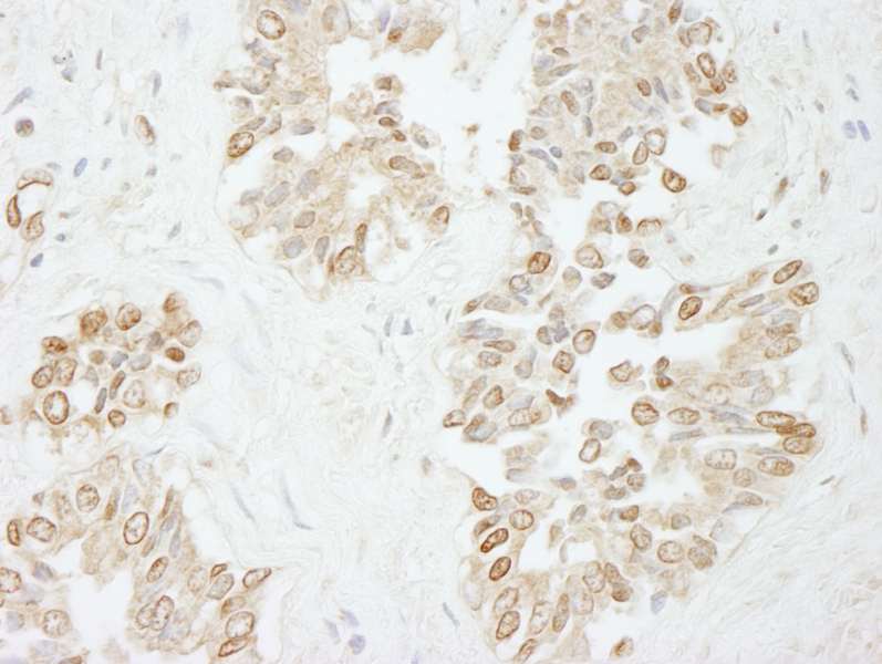 Detection of Human Pol Lambda by Immunohistochemistry. Sample: FFPE section of human prostate nodular hypertrophy. Antibody: Affinity purified rabbit anti-Pol Lambda used at a dilution of 1:250.