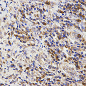 Immunohistochemistry of paraffin-embedded human lung cancer using POLR1C antibody at dilution of 1:200 (x400 lens)