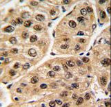 Formalin-fixed and paraffin-embedded human hepatocarcinoma tissue reacted with POLR1C antibody , which was peroxidase-conjugated to the secondary antibody, followed by DAB staining. This data demonstrates the use of this antibody for immunohistochemistry; clinical relevance has not been evaluated.
