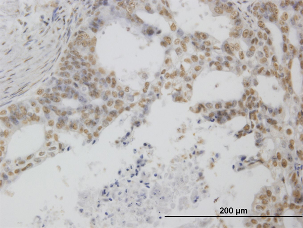 Immunoperoxidase of monoclonal antibody to POLR1C on formalin-fixed paraffin-embedded human pancreatic cancer. [antibody concentration 0.6 ug/ml]