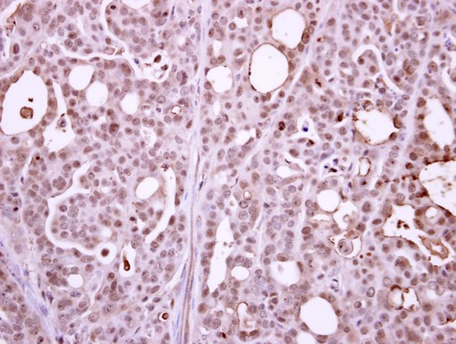 IHC of paraffin-embedded NCIN87 xenograft using POLR2B antibody at 1:500 dilution.