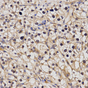 Immunohistochemistry of paraffin-embedded human kidney cancer using POLR2I antibody at dilution of 1:200 (x400 lens)