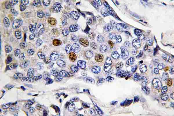 IHC of POLR3A (P68) pAb in paraffin-embedded human breast carcinoma tissue.
