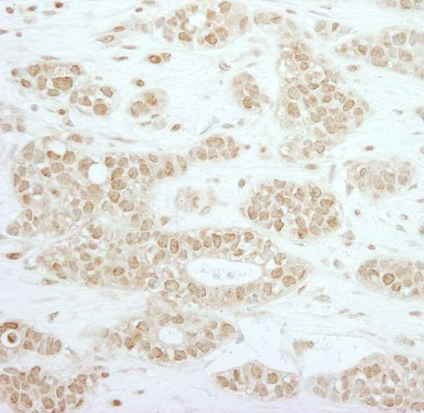 Detection of Human RPC2 by Immunohistochemistry. Sample: FFPE section of human breast carcinoma. Antibody: Affinity purified rabbit anti-RPC2 used at a dilution of 1:500.