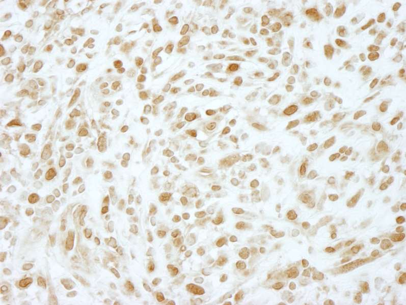 Detection of Human RPC2 by Immunohistochemistry. Sample: FFPE section of human Hodgkin's Lymphoma. Antibody: Affinity purified rabbit anti-RPC2 used at a dilution of 1:250.