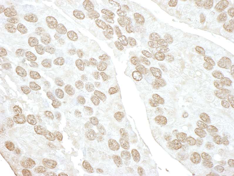 Detection of Human POLR3D by Immunohistochemistry. Sample: FFPE section of human prostate carcinoma. Antibody: Affinity purified rabbit anti-POLR3D used at a dilution of 1:100.